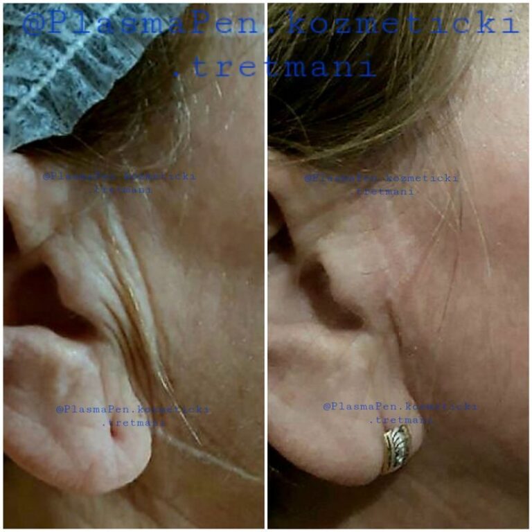 PlasmaPenKozmetickiTretmani01--16