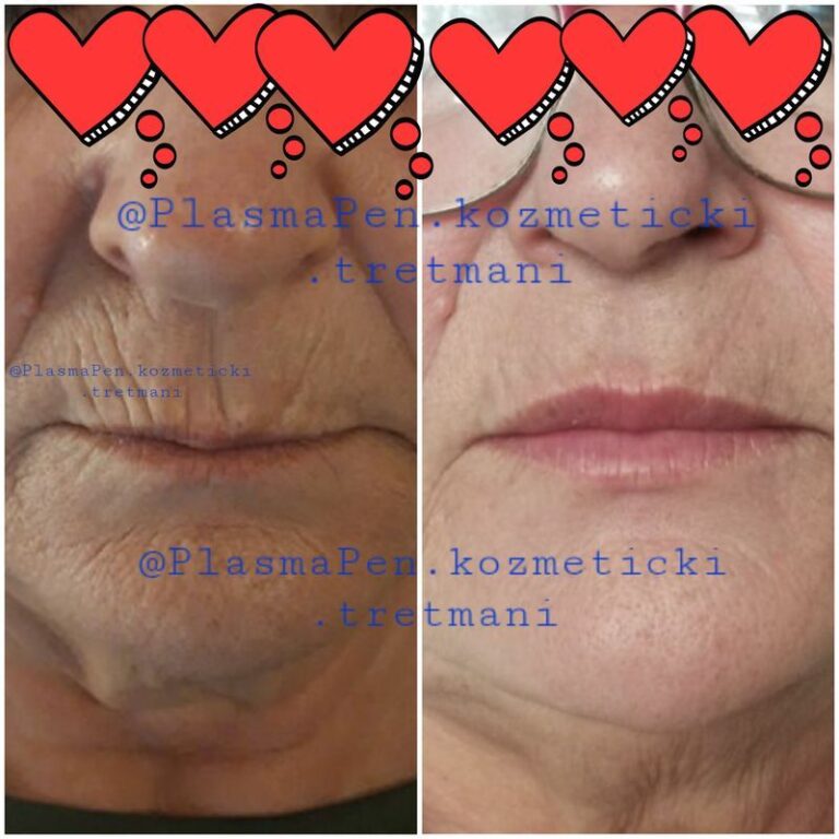 PlasmaPenKozmetickiTretmani01--19