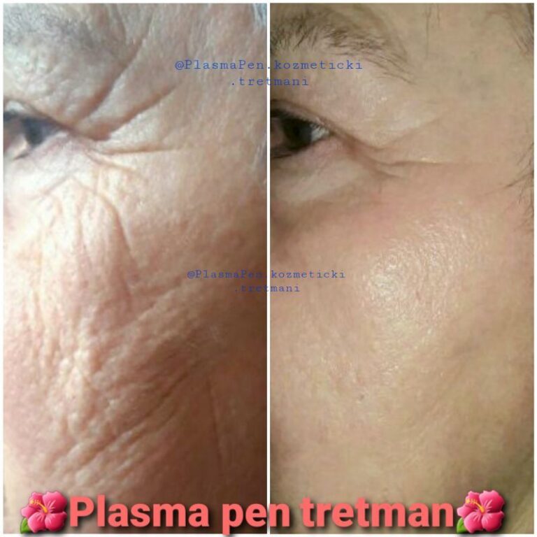 PlasmaPenKozmetickiTretmani01--21