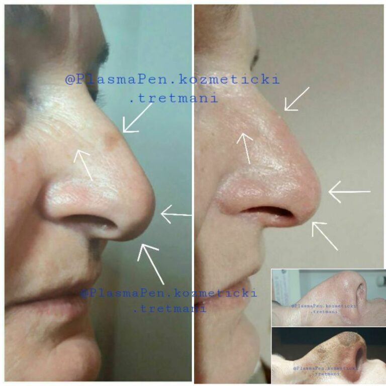 PlasmaPenKozmetickiTretmani01--26