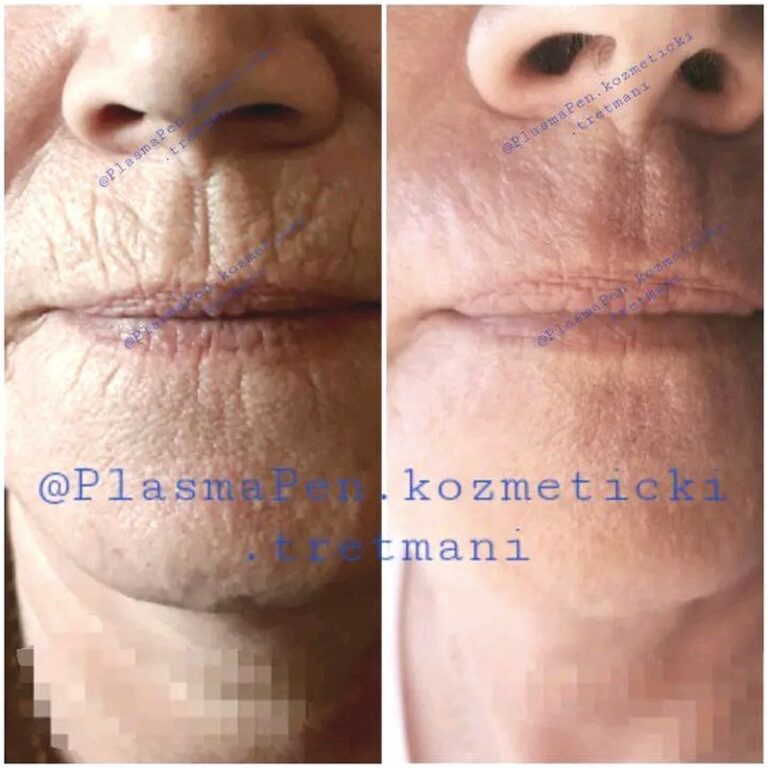 PlasmaPenKozmetickiTretmani01--32