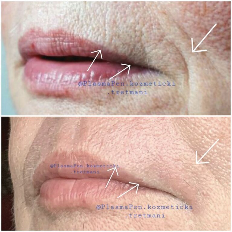 PlasmaPenKozmetickiTretmani01--33